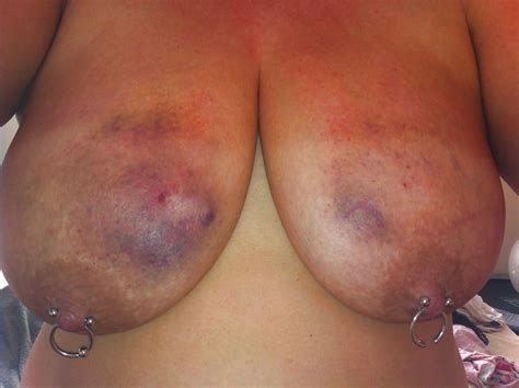 Scottish Sluts Loving Bruised Tits Porn Pictures XXX Photos Sex Images PICTOA