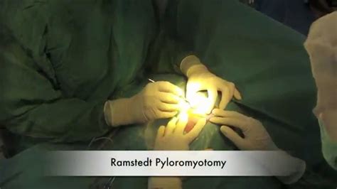 Pediatric Pyloric Stenosisramstedt Pyloromyotomy Dr C Astini Dr M