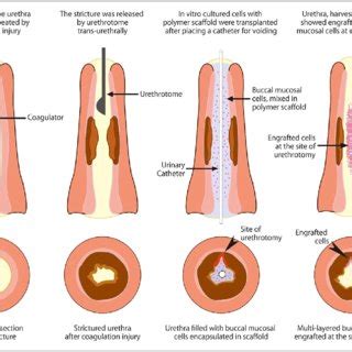 A Pre Stricture Urethrogram B Electro Coagulator Inside The Urethra