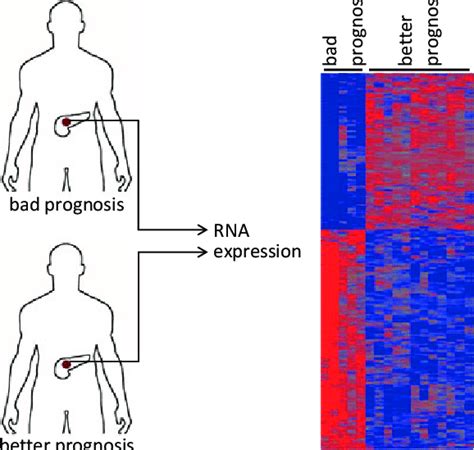 RNA expression analysis of PDAC predicts the clinical outcome. Heat map ...