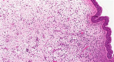Pathology Outlines Inflammatory Sinonasal Polyp