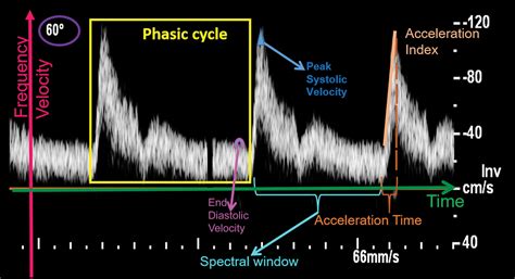 Optimizing Image Quality When Evaluating Blood Flow At Doppler Us A