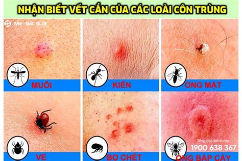 Vết Côn Trùng Cắn Sưng Đỏ Ngứa Làm Sao Để Xử Lý Nhanh Và Hiệu Quả