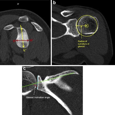 Distribution Of The Humeral Head Inclination Angle A And Retroversion