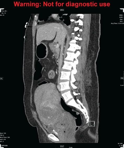 B CT Of Abdomen And Pelvis Sagittal A Markedly Enlarged Uterus