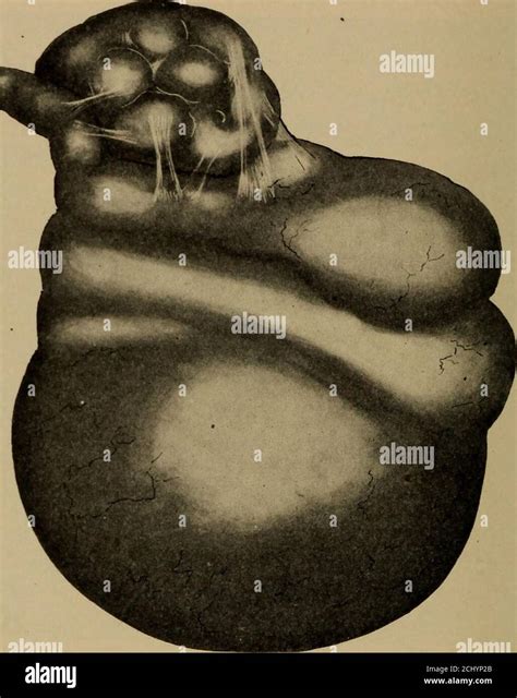 Salpingitis isthmica nodosa hi-res stock photography and images - Alamy