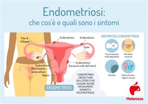 Endometriosi che cos è sintomi cause diagnosi e cure