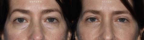 Blepharoplasty Before And After Patient 05 Kerolus