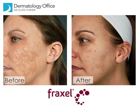 Fraxel Acne Scars Before And After