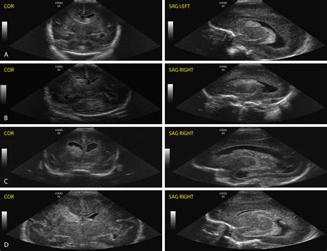 Intraventricular Hemorrhage in the Neonate - Clinical Tree