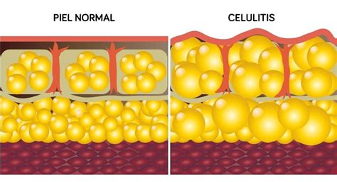 Celulitis edematosa, qué es, síntomas, causas y tratamiento