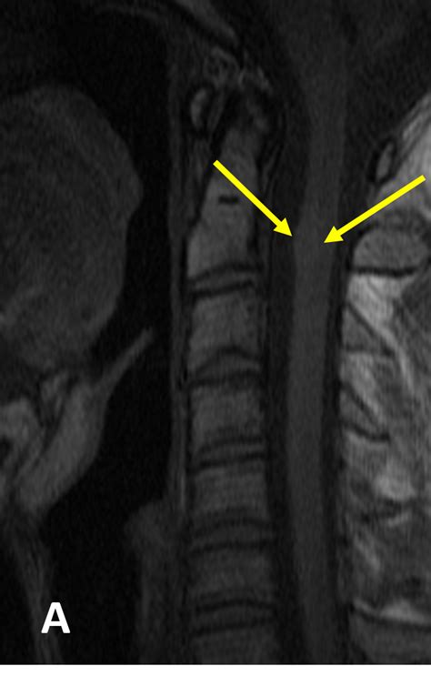 Cavernous Malformation Cm Of The Spine Diagnosis Mri Online