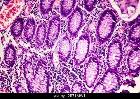 L Ad Nocarcinome Peu Diff Renci De La Lumi Re Intestinale