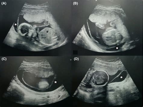 Spontaneous chorioamniotic membrane separation discovered by preterm