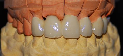 Prótesis fijas – Dental Topdeca