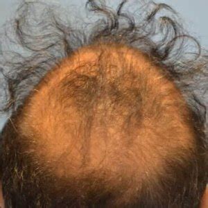 Hair Transplant Fails: Technician Errors, Bad Grafts, & More