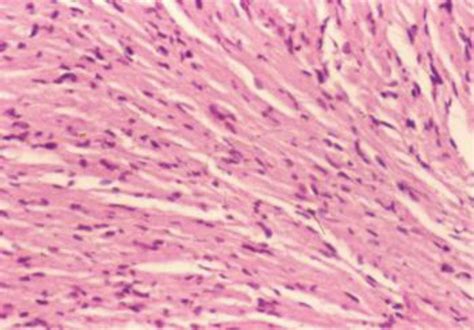 Schwannoma Consisting Of Closely Apposed Spindle Shaped Cells In A