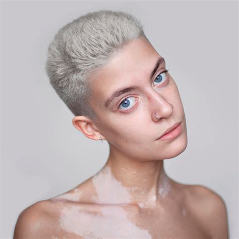 Как я живу с витилиго | Витилиго, Человек, Средства для кожи