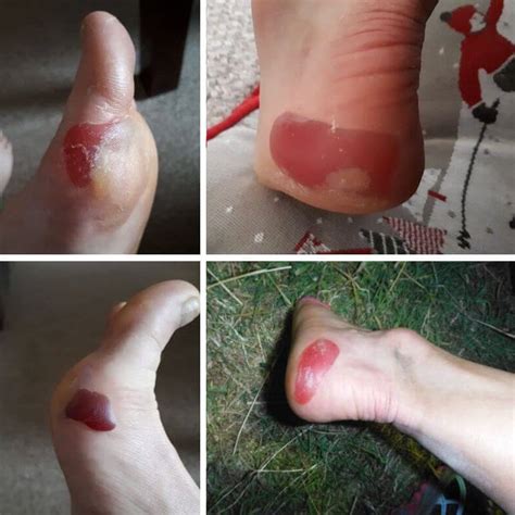 Blister On The Heel Of My Foot Outlet Emergencydentistry