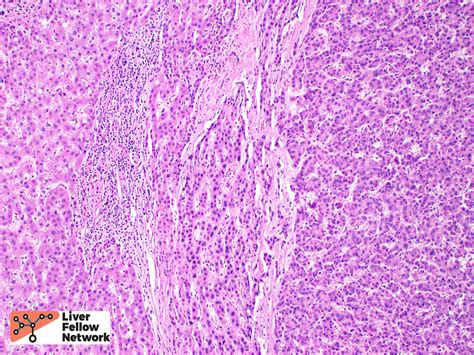 Pathology Pearls Hepatocellular Carcinoma Aasld