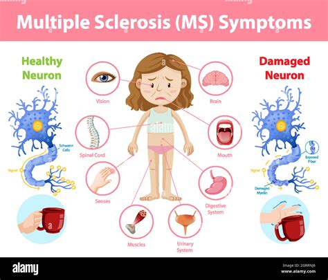 Multiple Sclerosis Ms Symptoms Information Infographic Stock Vector