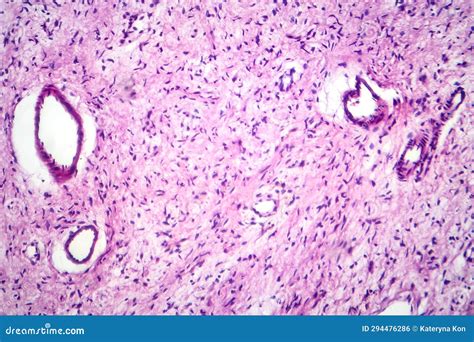 A Neurofibroma Tissue Sample In Neurofibromatosis Genetic Disease