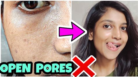 Open Pores Treatment Naturally At Home In Just 2 Steps 😍 Youtube