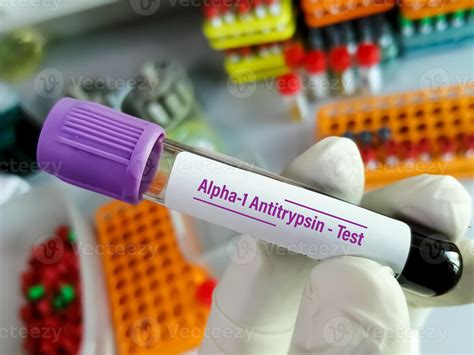 cientista segura tubo de amostra de sangue para teste de alfa 1
