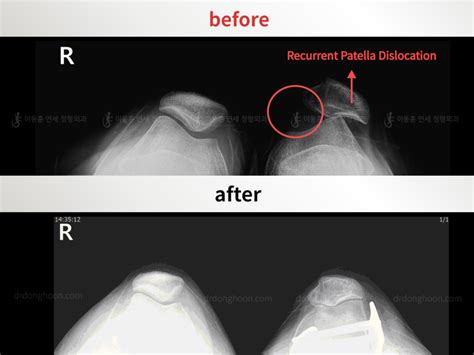 Recurrent Patella Dislocation Recurrent Patella Dislocation