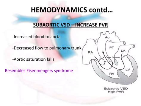 double outlet  ventricle pptx