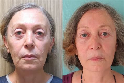 What Is Face And Neck Lift Vanity