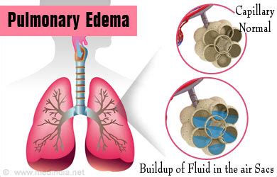 Pulmonary Edema Causes Symptoms Signs Diagnosis Treatment Prevention