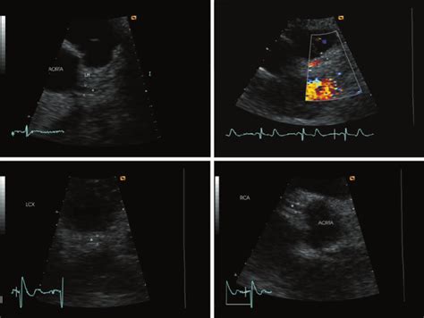 TTE : Transthoracic Echocardiogram - SIFSOF . CA