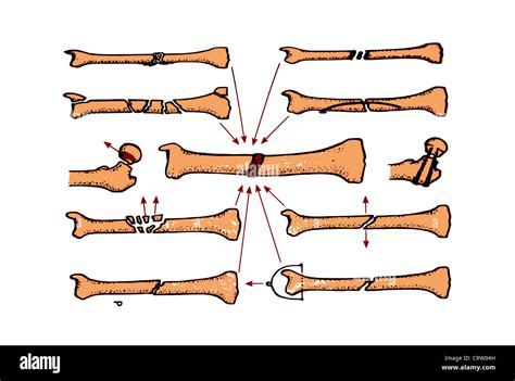 wrist fracture recovery  treatment options