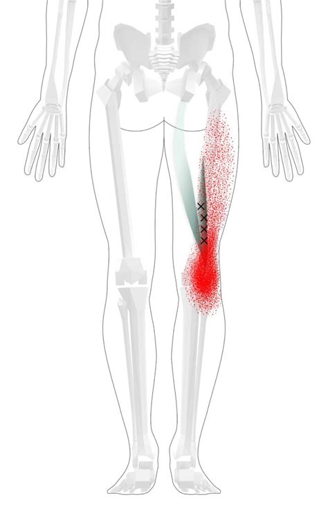 Biceps Femoris Trigger Points Overview Self Treatment Tips