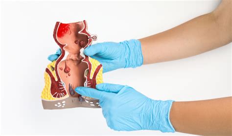 Anal Fistül Ameliyatı ve Sonrası Yapılması Gerekenler