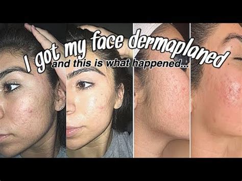 DERMAPLANING BEFORE AND AFTER *with footage* - YouTube