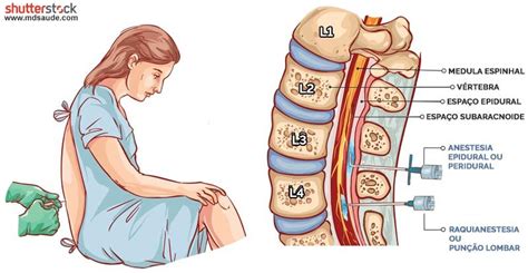 Quanto Tempo A Anestesia Raqui Fica No Organismo - Raquianestesia: o que é, efeitos colaterais e anatomia