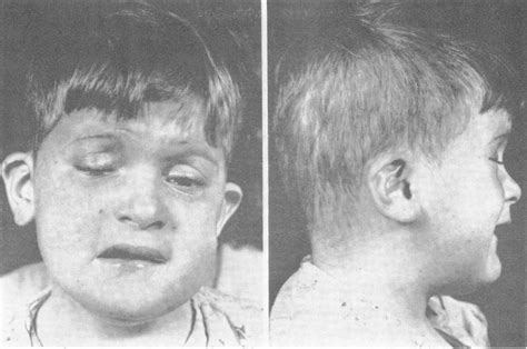 Figure 1 From Trisomy 9 Mosaicism With Multiple Congenital Anomalies Semantic Scholar