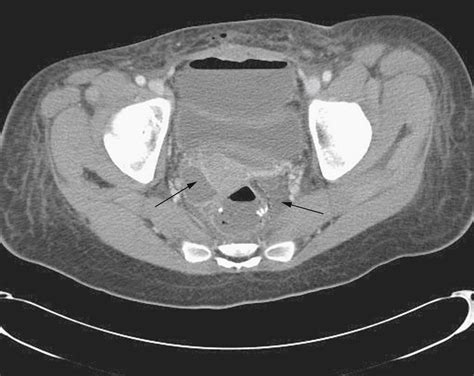 Ileostomies Colostomies Pouches And Anastomoses Clinical Tree