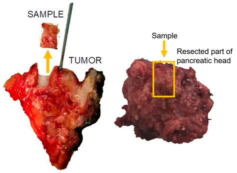 Contrast-Enhanced Computed Tomography and Laboratory Parameters as Non-Invasive Diagnostic