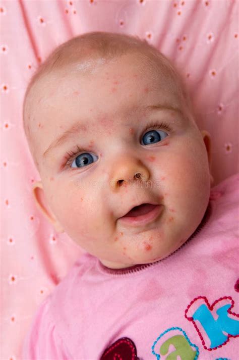 baby  chicken pox stock image image  child funny