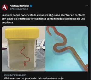 Cirujanos Extraen Un Gusano Vivo Del Cerebro De Una Paciente