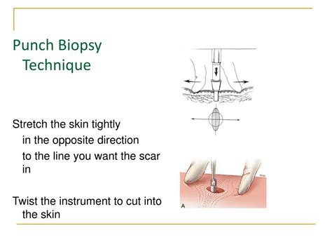 Ppt Punch Biopsies For The Dermatological Nurse Powerpoint
