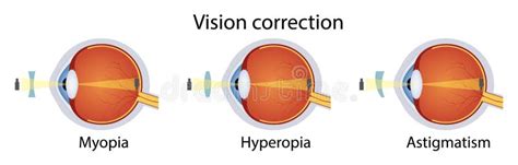 Correction Of Various Eye Vision Disorders By Lens Hyperopia Myopia