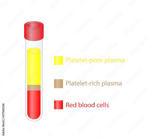 Platelet Rich Plasma Prp Autologous Conditioned Plasma Is A