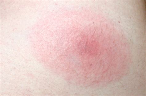 What Does A Tick Bite Rash Look Like