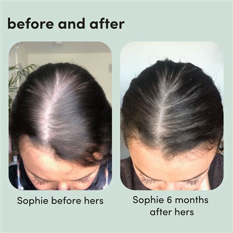 Hair Growth Without Minoxidil at Krista Guerrero blog