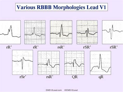 Rbbb Vs Lbbb