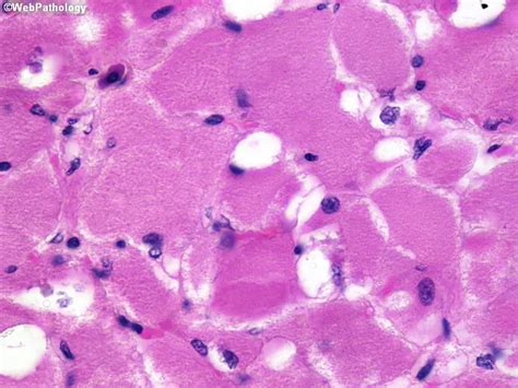 Adult Rhabdomyoma